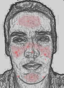 Natural Remedies for Rosacea (also acne Rosacea) - do's and don'ts